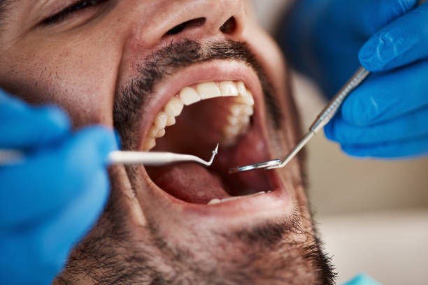 Best Emergency Treatment for Dental Infections or Abscesses in Glasgow, DE